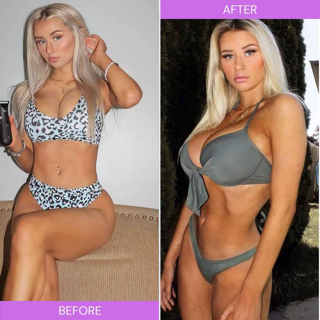 Are Mikayla Demaiter Tits Real? | Mikayla Demaiter Plastic Surgery?