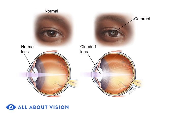 early cataract stages pictures