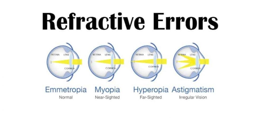 refraction disorder